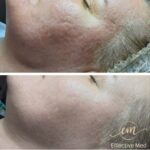 Aplikacja aktywnej mieszanki alg DECAAR na skórę twarzy